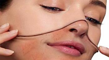 Сосудистые звездочки на лице