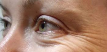 Коварство «гусиных лапок»